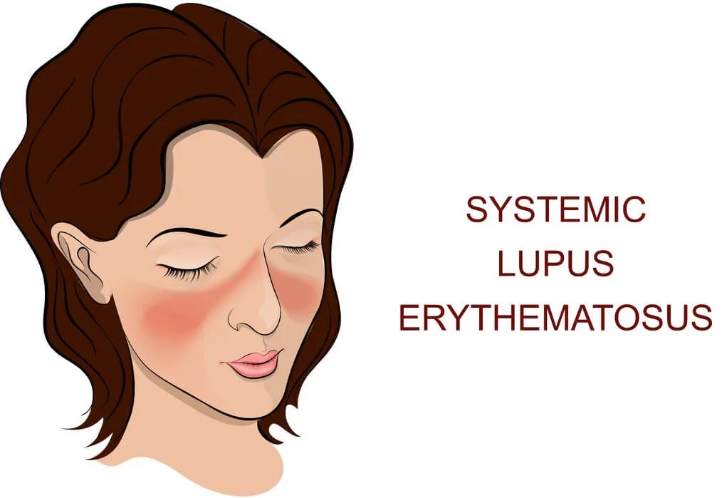 Lupus Treatment